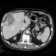Hepatocellular carcinoma, subcapsular bleeding: CT - Computed tomography